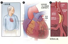 冠心病的起因是什么？