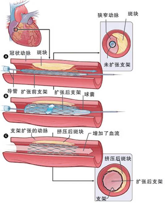 怎樣治療冠心??？(圖2)