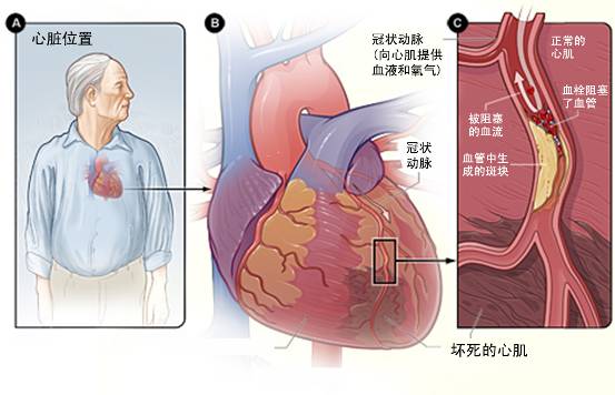 怎樣治療冠心??？(圖3)