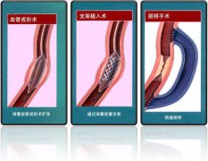 怎樣治療冠心??？