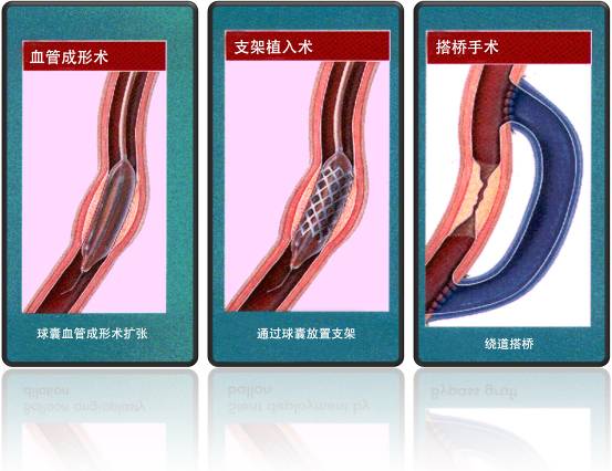 怎樣治療冠心??？(圖1)