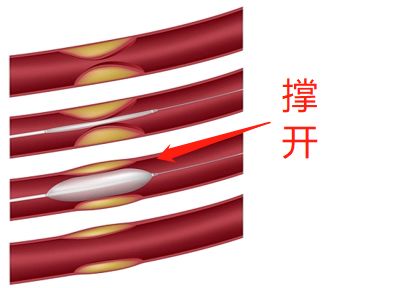 什么是藥物球囊？(圖2)